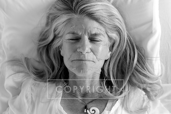 truhealthfit_acupuncture_206