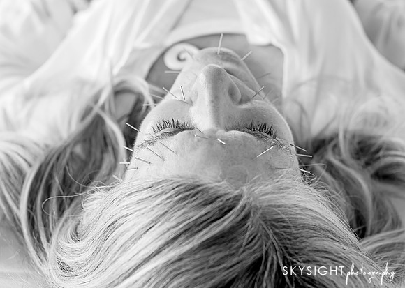 truhealthfit_acupuncture_210
