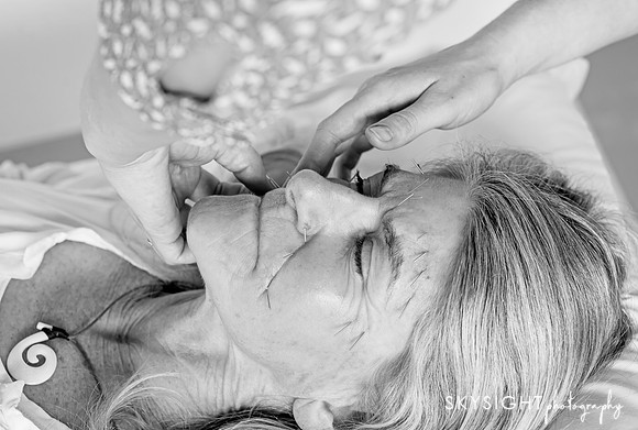 truhealthfit_acupuncture_202