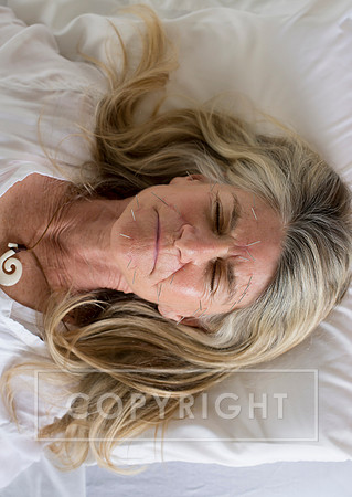 truhealthfit_acupuncture_207