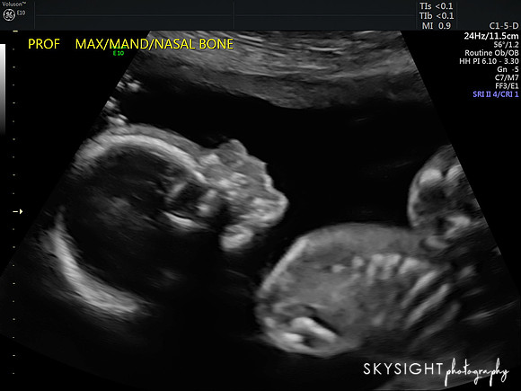 20 WKS (2)