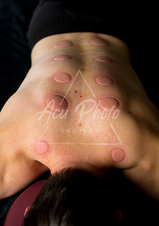 acupuncture-284