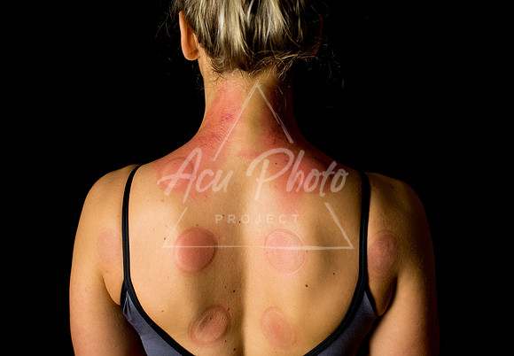 acupuncture-310