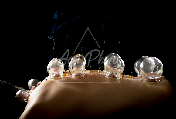 acupuncture-272