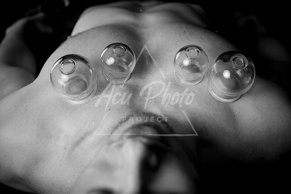acupuncture-216