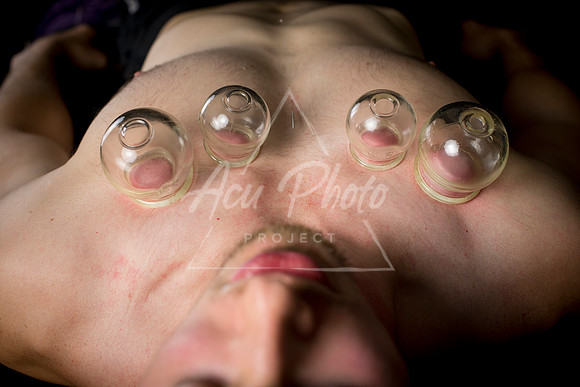acupuncture-217