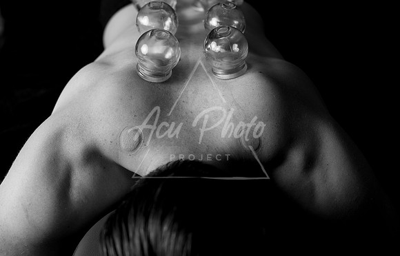 acupuncture-248