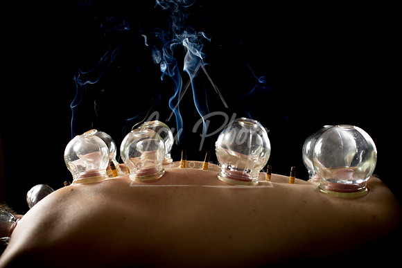 acupuncture-270