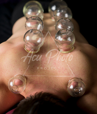 acupuncture-245