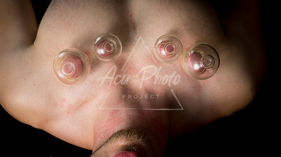acupuncture-219