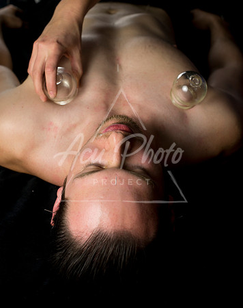 acupuncture-211