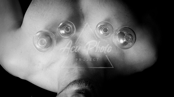 acupuncture-218