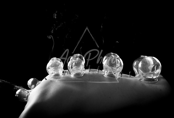 acupuncture-271