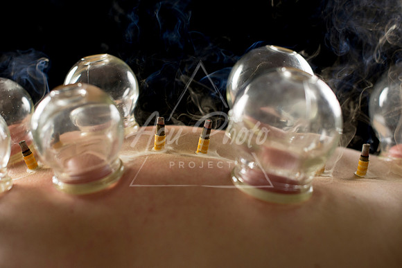 acupuncture-274