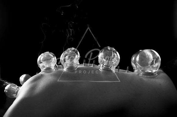 acupuncture-279