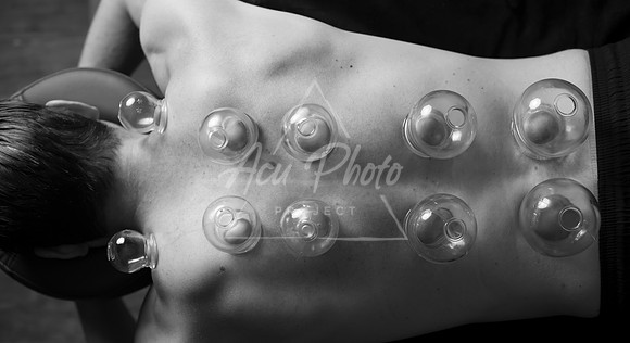 acupuncture-240