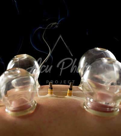 acupuncture-282
