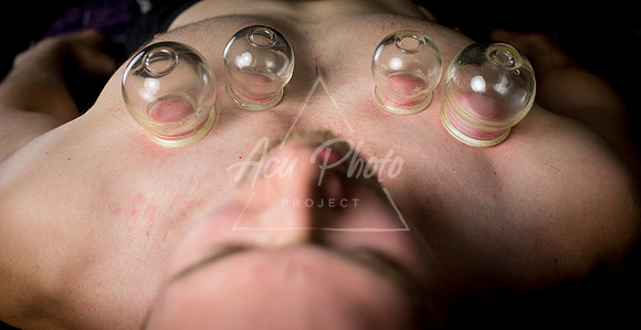acupuncture-215