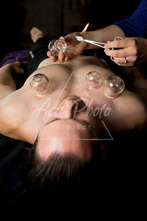 acupuncture-213