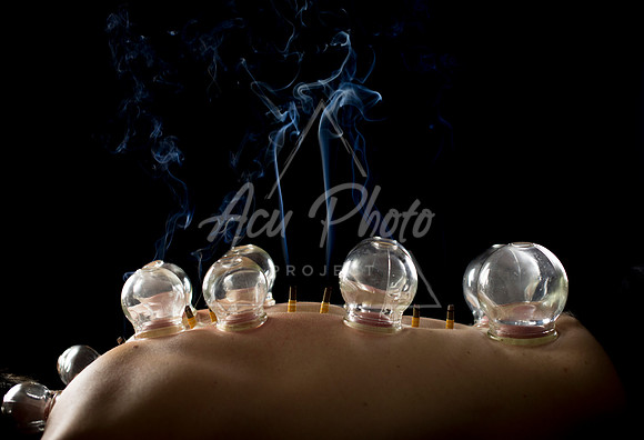 acupuncture-266