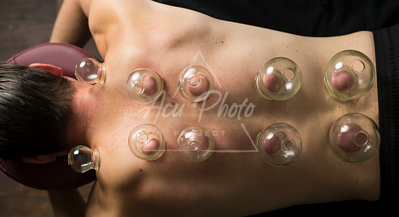 acupuncture-241
