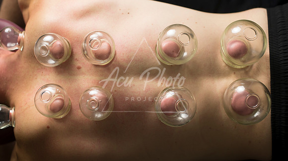 acupuncture-243