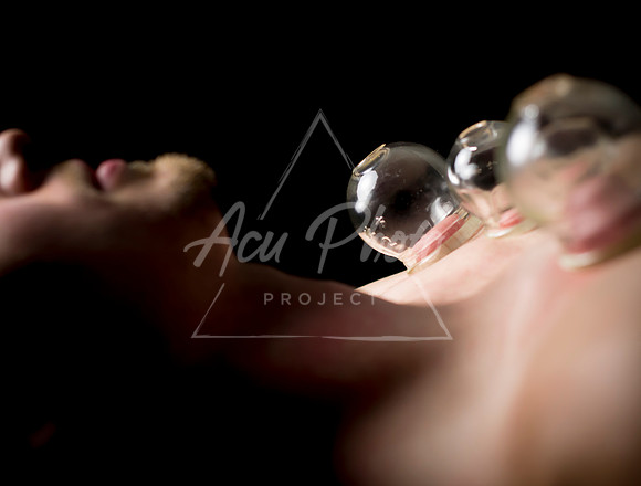 acupuncture-225