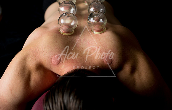 acupuncture-249