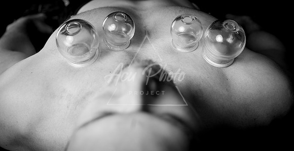 acupuncture-214