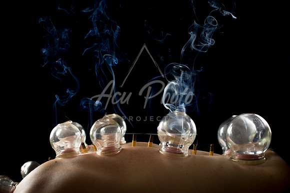 acupuncture-262