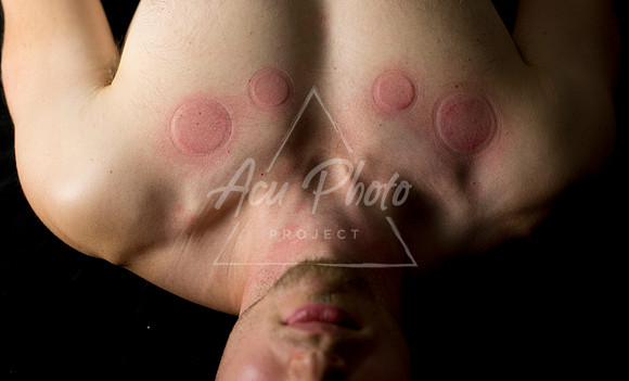 acupuncture-229