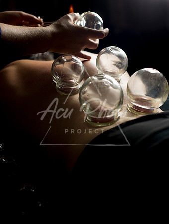acupuncture-233