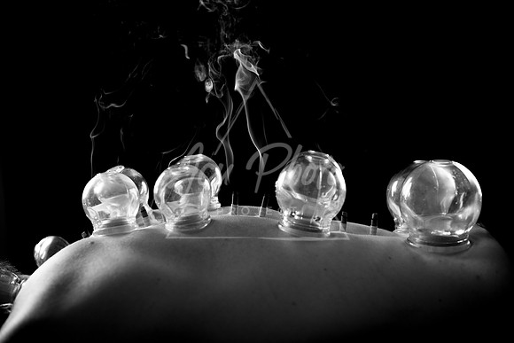 acupuncture-269