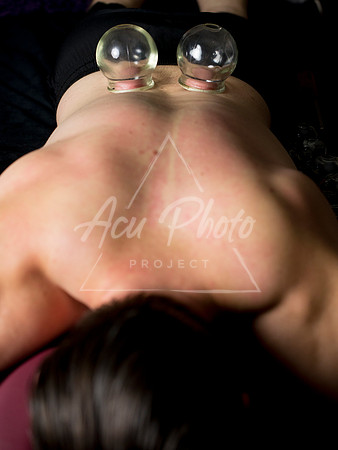 acupuncture-231