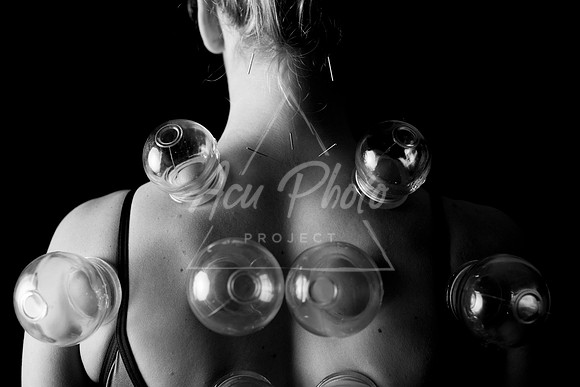 acupuncture-299