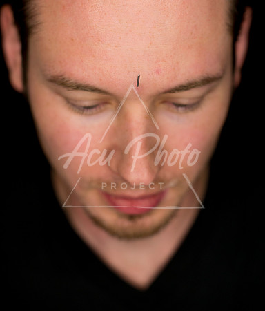 acupuncture-351