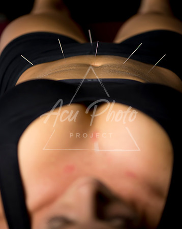 acupuncture-021