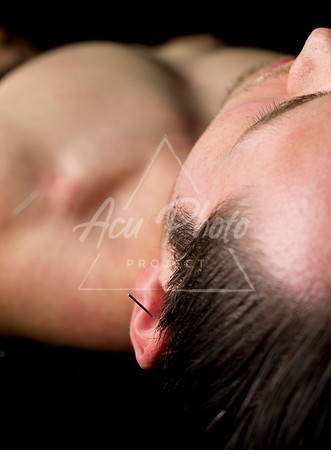 acupuncture-176