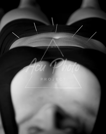acupuncture-020