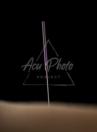 acupuncture-019