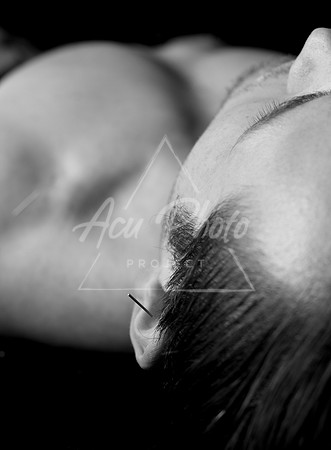 acupuncture-175