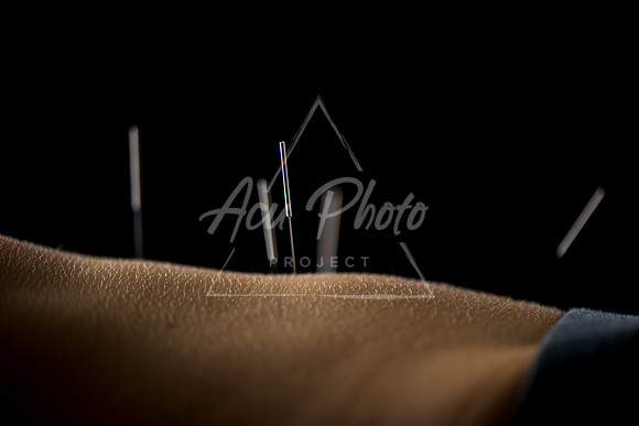 acupuncture-017