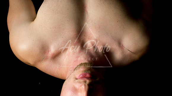 acupuncture-178
