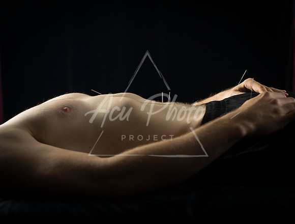 acupuncture-182