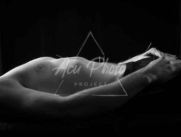 acupuncture-181