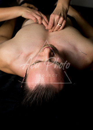 acupuncture-167