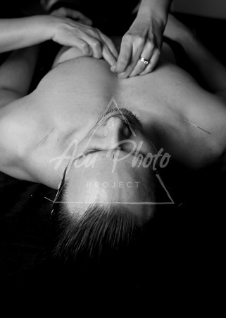 acupuncture-166