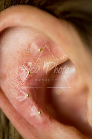 acupuncture project2_078