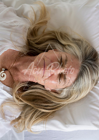 truhealthfit_acupuncture_207