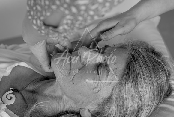 truhealthfit_acupuncture_202